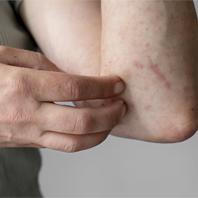 orticaria: sintomi, cause e quando rivolgersi all'allergologo o al dermatologo