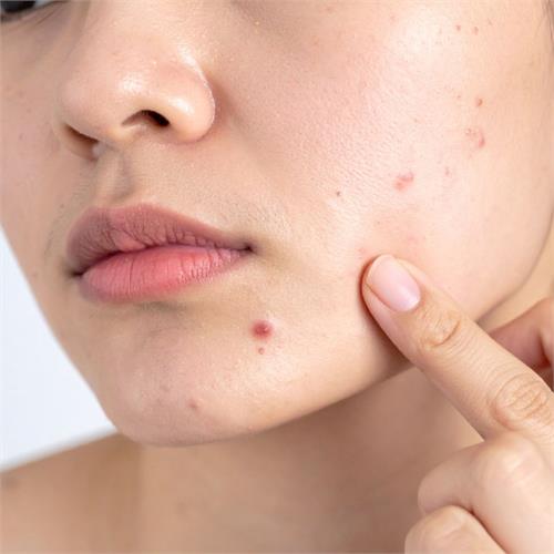 peeling chimico e acne: un trattamento mirato per riequilibrare la pelle