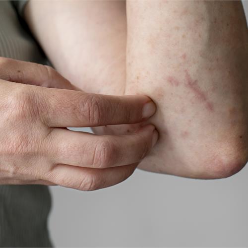orticaria: sintomi, cause e quando rivolgersi all'allergologo o al dermatologo